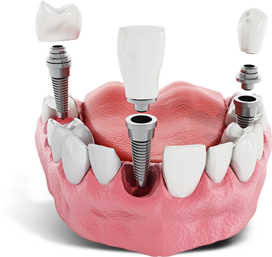 Dental Implant Model 2 blue and green curve menu Jacksonville, AL