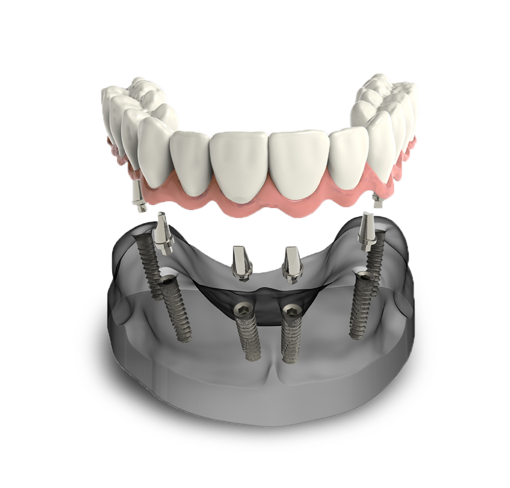 Implant supported denture model Regional Dental Center Jacksonville, AL