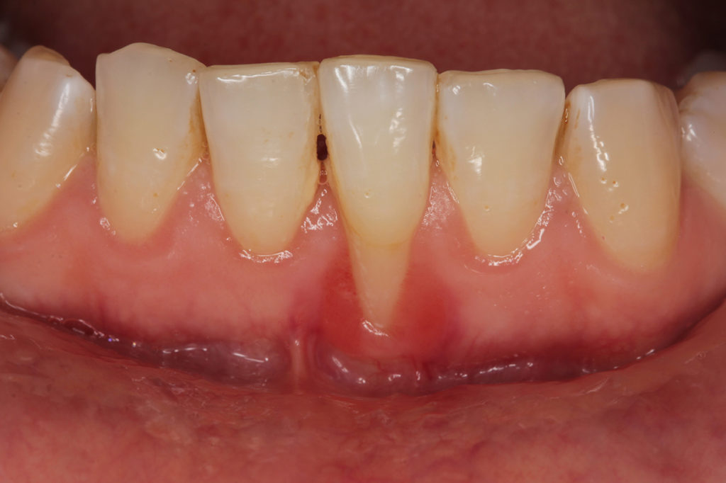 Patient with Gum Recession at Gum RecessionRegional Dental Center Jacksonville, AL