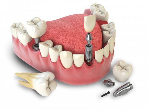 Dental Implant Model blue and green curve menu Jacksonville, AL