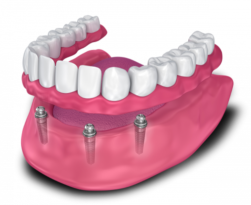 Implant supported denture model Jacksonville, AL