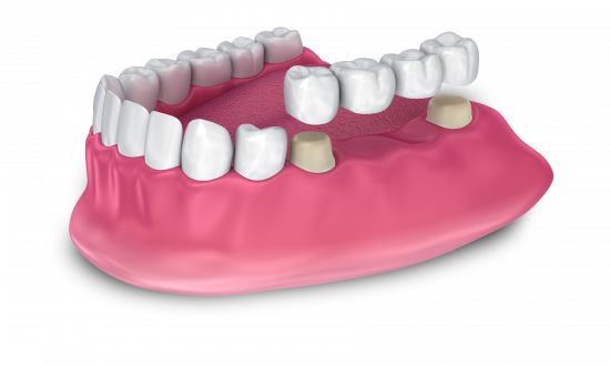 dental Crown and Bridges model Jacksonville, AL